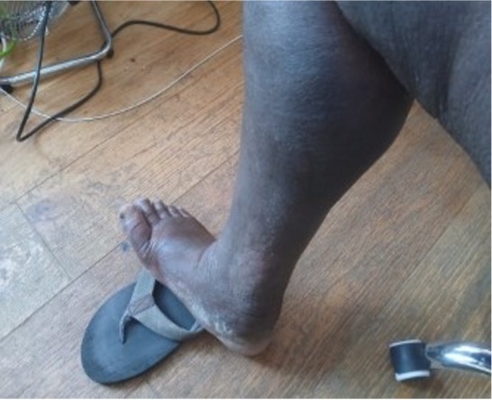 my oedema ravaged legs